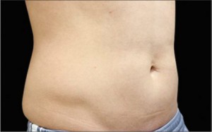 CoolSculpting