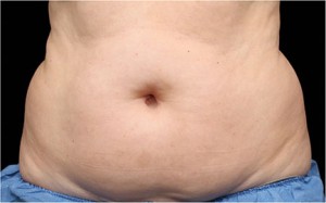 CoolSculpting