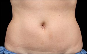 CoolSculpting