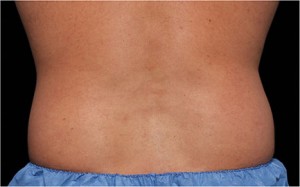 CoolSculpting