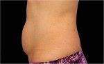 CoolSculpting