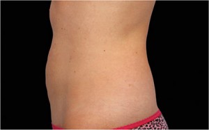 CoolSculpting