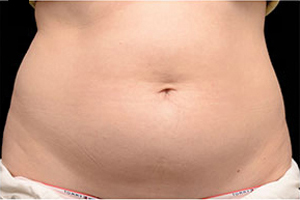 CoolSculpting