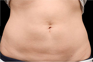 CoolSculpting