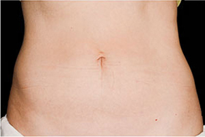 CoolSculpting